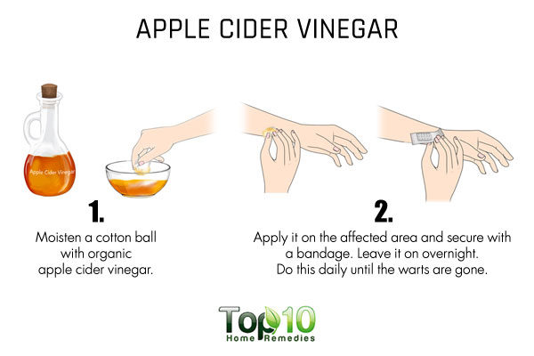 apple cider vinegar to dry up flat warts