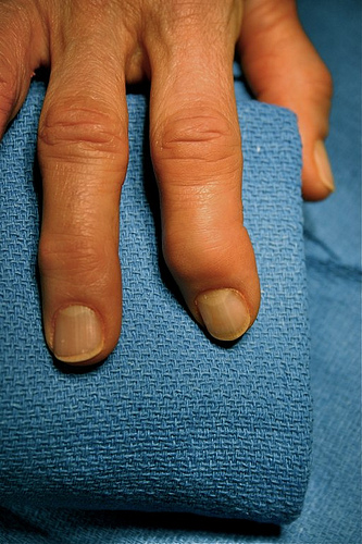 Arthritis photo