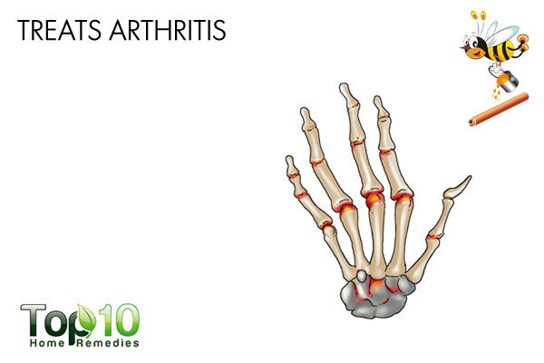cinnamon and honey treats arthritis
