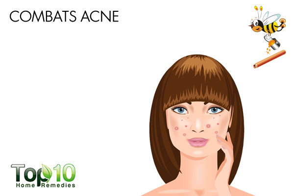 cinnamon and honey combat acne