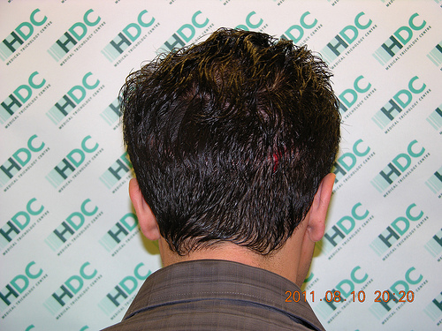 hairloss photo